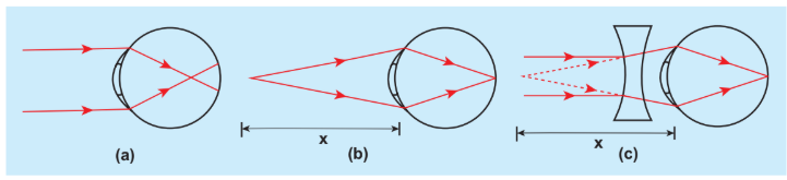 Figure 7.47 Myopic eye and correction