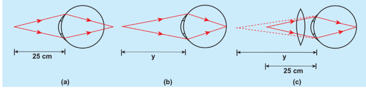 Figure 7.48 Hypermetropic eye and correction